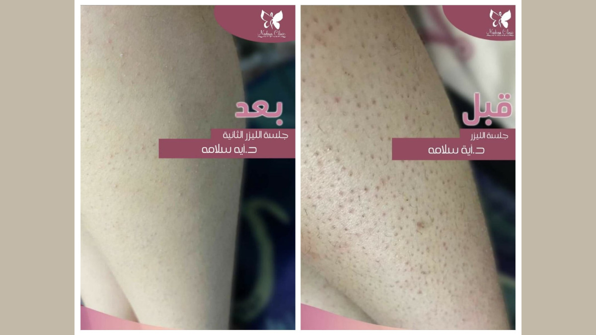 التخلص من جلد الوزة في الغردقة